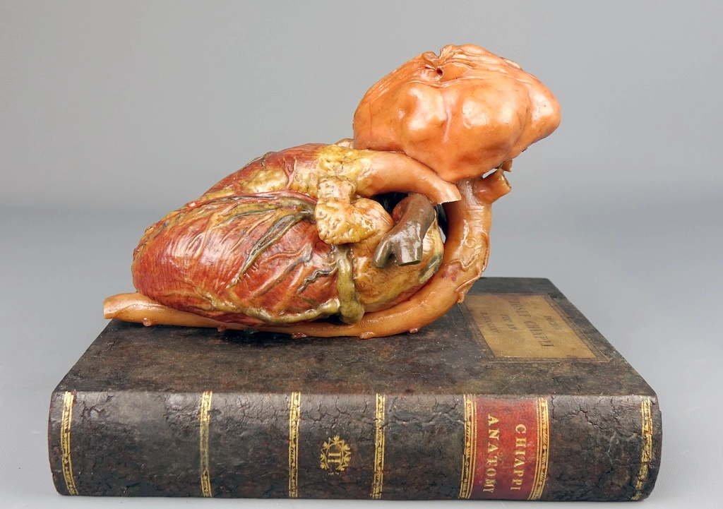 Joseph Chiappi Cire anatomique représentant un cœur avec un anévrisme sur la crosse et l’artère pulmonaire